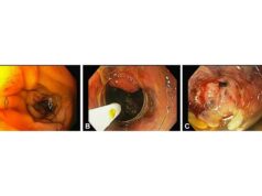Uma lesão duodenal com risco de vida pode ser curada usando três técnicas endoscópicas avançadas
