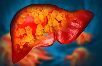 Clínica Mayo descobre mutação genética rara que causa doença hepática gordurosa