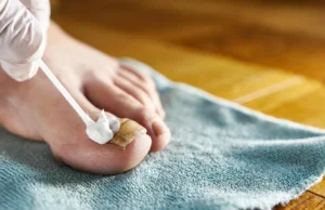 O cheiro de ovo podre que pode finalmente derrotar fungos nas unhas