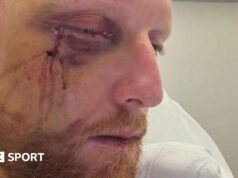 Ben Stokes: Capitão de testes da Inglaterra passa por cirurgia na maçã do rosto quebrada