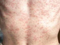 Relate a exposição ao sarampo ao pronto-socorro do Oregon City Hospital.