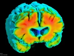 A doença de Alzheimer pode começar com uma queda silenciosa no fluxo sanguíneo para o cérebro