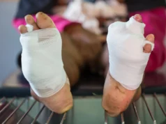 Um novo gel de oxigênio pode prevenir a amputação em pacientes com diabetes