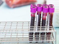 Um simples exame de sangue pode eventualmente dizer quando o Alzheimer está chegando