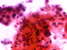 Oregon aprova projeto de lei para facilitar o rastreamento e o tratamento do câncer cervical