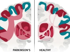 Cientistas podem ter encontrado a rede cerebral por trás da doença de Parkinson
