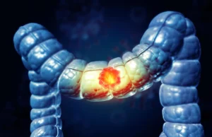 A maioria dos americanos não sabe que esses alimentos aumentam o risco de câncer de cólon