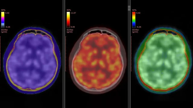 pet-ct-scan-of-human-brain-triple-view.webp.webp