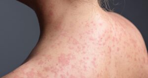 Erupção cutânea de sarampo é “difícil de detectar” em crianças enquanto os médicos perseguem um surto massivo