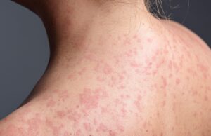 Erupção cutânea de sarampo é “difícil de detectar” em crianças enquanto os médicos perseguem um surto massivo