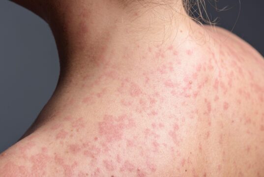 Erupção cutânea de sarampo é “difícil de detectar” em crianças enquanto os médicos perseguem um surto massivo