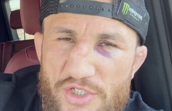 Ex-campeão do UFC quebra o nariz em treino Optou por não fazer cirurgia corretiva.