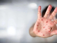 A crise do sarampo em Bangladesh piora à medida que o número de mortos se aproxima de 300 em meio a lacunas nas vacinas