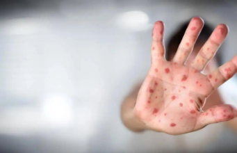 O número de mortes por sarampo em Bangladesh aumentou para 280 à medida que o surto se intensifica