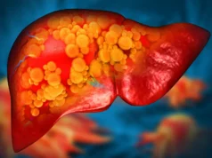 Um novo medicamento pode finalmente parar a doença hepática gordurosa fatal