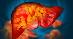 Um novo medicamento pode finalmente parar a doença hepática gordurosa fatal