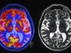 Exames cerebrais revelam dois tipos diferentes de autismo