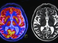 Exames cerebrais revelam dois tipos diferentes de autismo