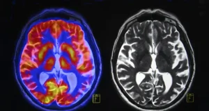 Exames cerebrais revelam dois tipos diferentes de autismo