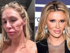 Brandi Glanville diz que seu parasita facial está de volta: ‘Achei que estava curada’