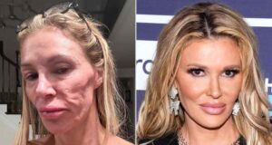 Brandi Glanville diz que seu parasita facial está de volta: ‘Achei que estava curada’