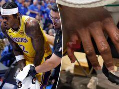 Jarred Vanderbilt, do Lakers, compartilha fotos gráficas de uma terrível lesão no dedo