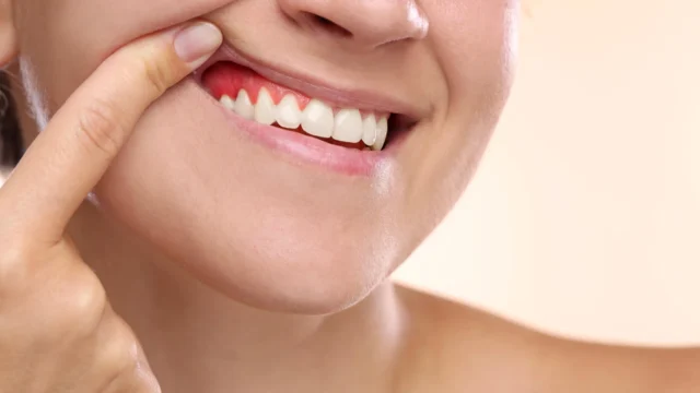woman-showing-inflamed-gum-disease.webp.webp