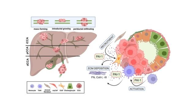 SERPINE1-Role-in-Cholangiocarcinoma-Progression-and-a-Therapeutic-Target-in-the-Desmoplastic-Microen.jpeg