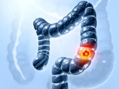 Os cientistas finalmente descobriram como uma bactéria intestinal comum causa câncer de cólon