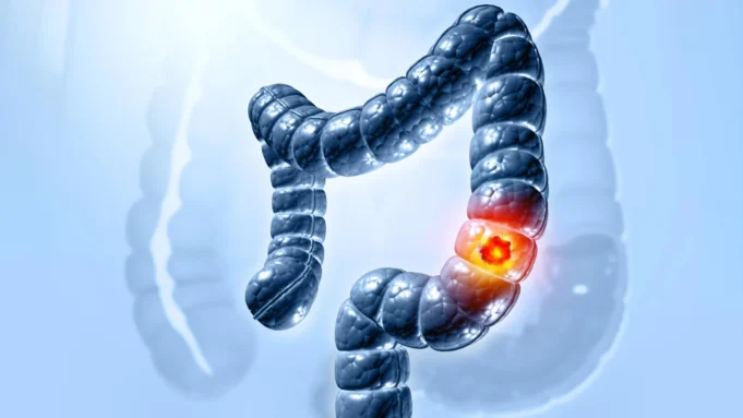 Os cientistas finalmente descobriram como uma bactéria intestinal comum causa câncer de cólon Os cientistas finalmente descobriram como uma bactéria intestinal comum causa câncer de cólon