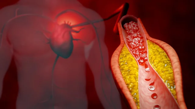 coronary-artery-disease.webp.webp