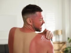 Como tratar queimaduras solares e envenenamento solar no calor do verão
