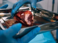 Quase metade dos pacientes transplantados renais nem começa