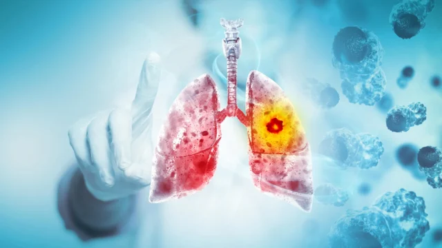 lung-cancer-bronchial-carcinoma.webp.webp